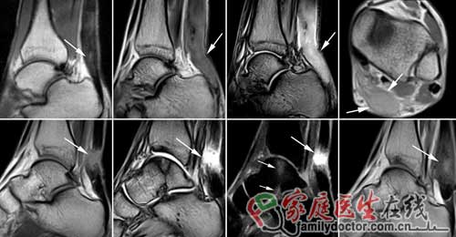 刘翔跟腱手术成功 专家：确诊及治疗有赖磁共振