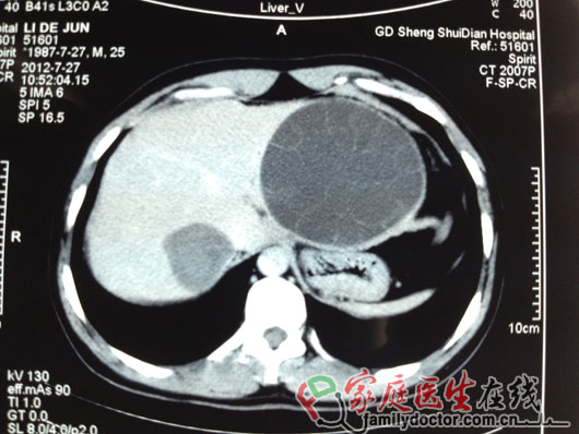 足球大小包虫囊手术成功取出 华侨医院治愈罕见肝包虫病