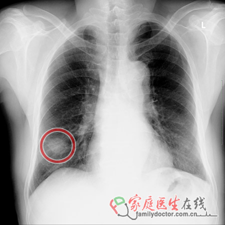 陶喆父亲陶大伟肺癌病逝 肺癌筛查靠什么？